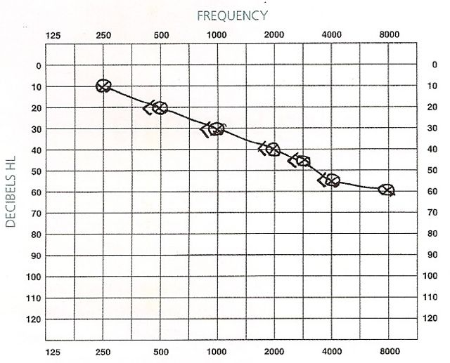 Garis grafik bone conduction dan air conduction menurun (di atas 25 dB) dan kedua garis grafik berhimpitan (tidak ada jarak di antaranya). (Hearing Australia. Audiograms | Aussie Deaf Kids [Internet]. www.aussiedeafkids.org.au. 2022. Available from: https://www.aussiedeafkids.org.au/audiograms.html)